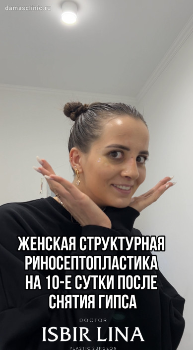Женская вторичная структурная риносептопластика на 10-е сутки после снятия гипса с фото- и видео-результатом. Первая операция проводилась у сторонних специалистов.