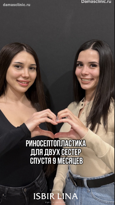 Риносептопластика для двух сестер спустя 9 месяцев в отзыве пациенток