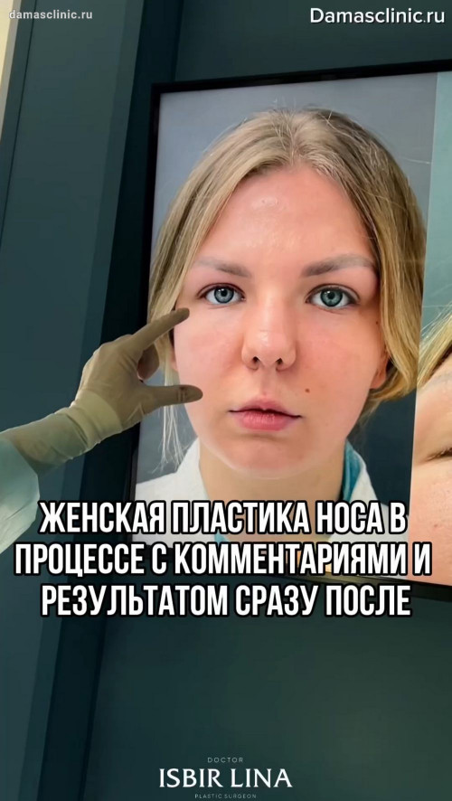 Женская пластика носа с толстой кожей в процессе с комментариями и результатом сразу после в видео
