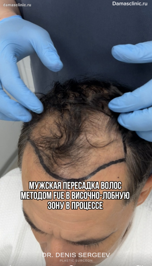 Мужская пересадка волос методом FUE в височно-лобную зону в процессе от Дениса Игоревича Сергеева