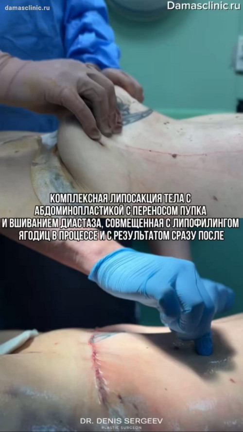 Комплексная липосакция тела с абдоминопластикой (перенос пупка и ушивание диастаза), совмещенные с липофилингом ягодиц: в процессе и с результатом сразу после от доктора Дениса Игоревича Сергеева