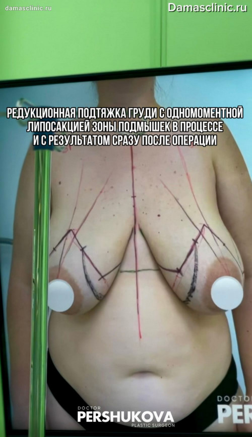 Редукционная подтяжка груди с одномоментной липосакцией зоны подмышек: в процессе и с результатом сразу после операции