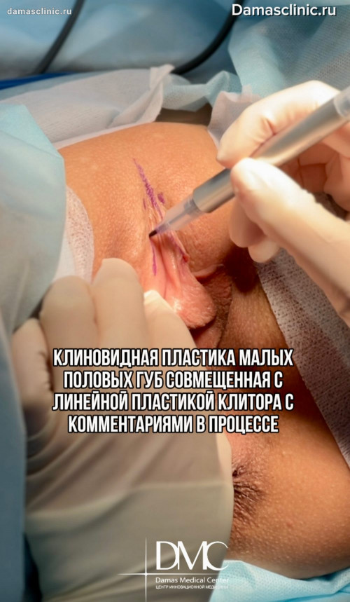 Клиновидная пластика малых половых губ и пластика клитора: до и через 3 недели после операции (с фото- и видео-результатами)