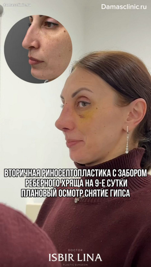 Вторичная риносептопластика с забором реберного хряща на 9-е сутки: плановый осмотр, снятие гипса