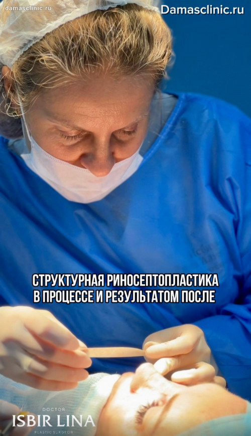 Структурная риносептопластика в процессе и с фото и видео результатом после