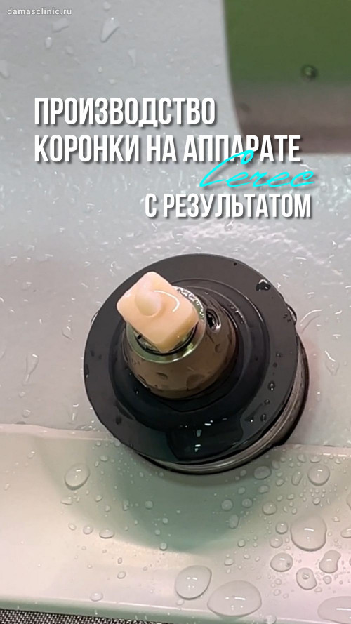 Производство и установка керамической коронки на аппарате Cerec / Церек за один визит