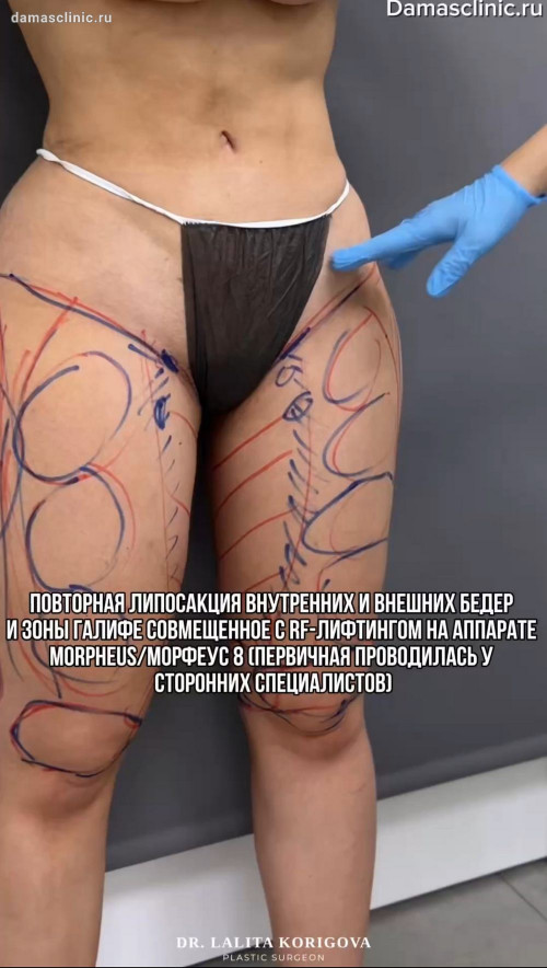 Повторная липосакция внутренних и внешних бедер и зоны галифе, совмещенная с RF-лифтингом на аппарате MORPHEUS / МОРФЕУС 8 (первичная проводилась у сторонних специалистов). Видео с комментариями доктора и фото результата