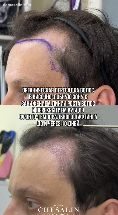 Органическая пересадка волос в височно-лобную зону с занижением линии роста волос и перекрытием рубцов фронто-темпорального лифтинга: до и через 10 дней (с фото-результатом)