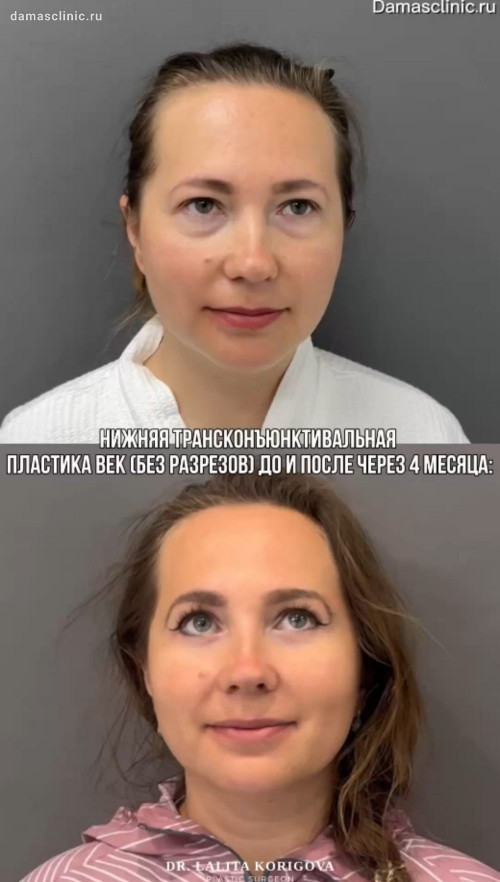 Нижняя трансконъюнктивальная пластика век (без разрезов) до и после через 4 месяца на осмотре у пластического хирурга - Лалиты Магомедовны Кориговой