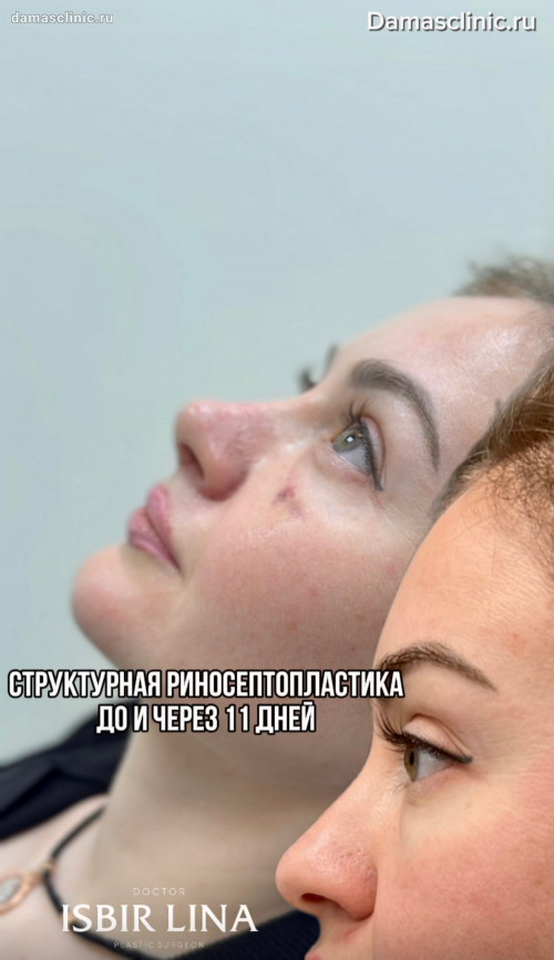 Структурная риносептопластика: до и через 11 дней после операции в видео