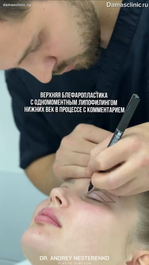Верхняя блефаропластика с одномоментным липофилингом нижних век в процессе