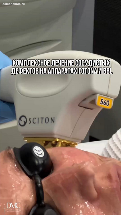 Комплексное лечение сосудистых дефектов на аппаратах Fotona и BBL: показания, результаты и процесс