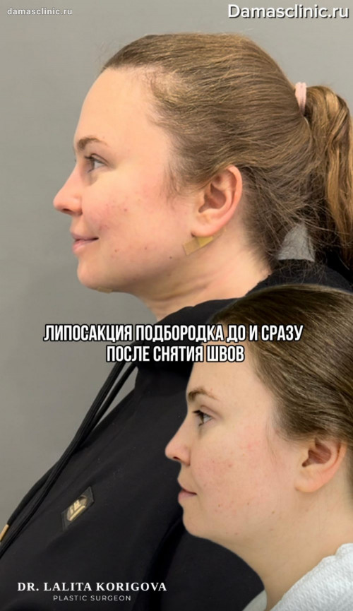 Липосакция подбородка: до и сразу после снятия швов (видео)