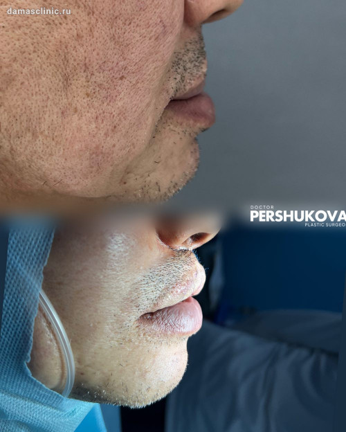 Мужская реконструкция верхней губы в процессе с фото результатами сразу после