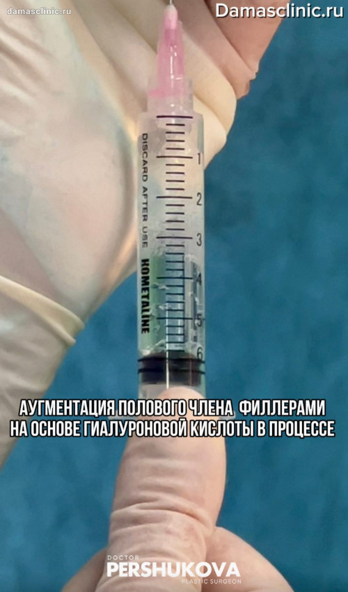 Аугментация полового члена филлерами на основе гиалуроновой кислоты в процессе