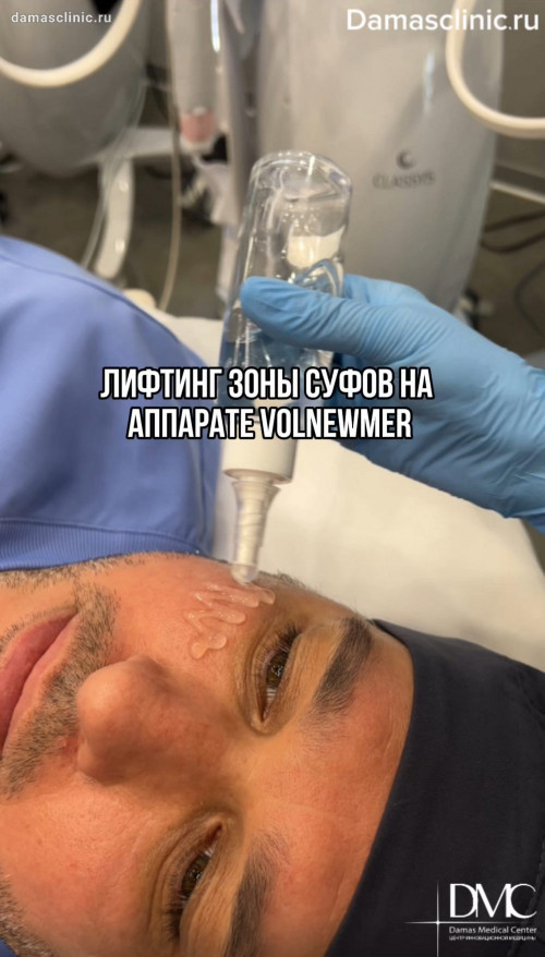Лифтинг зоны суфов на аппарате VOLNEWMER / ВОЛЬНЬЮМЕР: видео