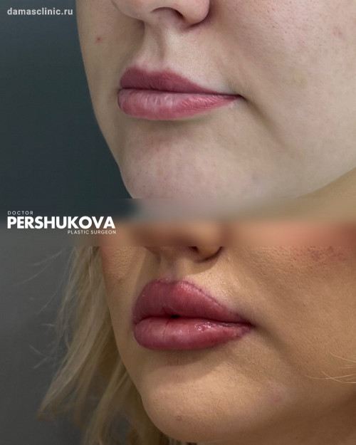 Пластика губ «КЕССЕЛЬРИНГ»: до и через 1 неделю на плановом осмотре с фото-результатами