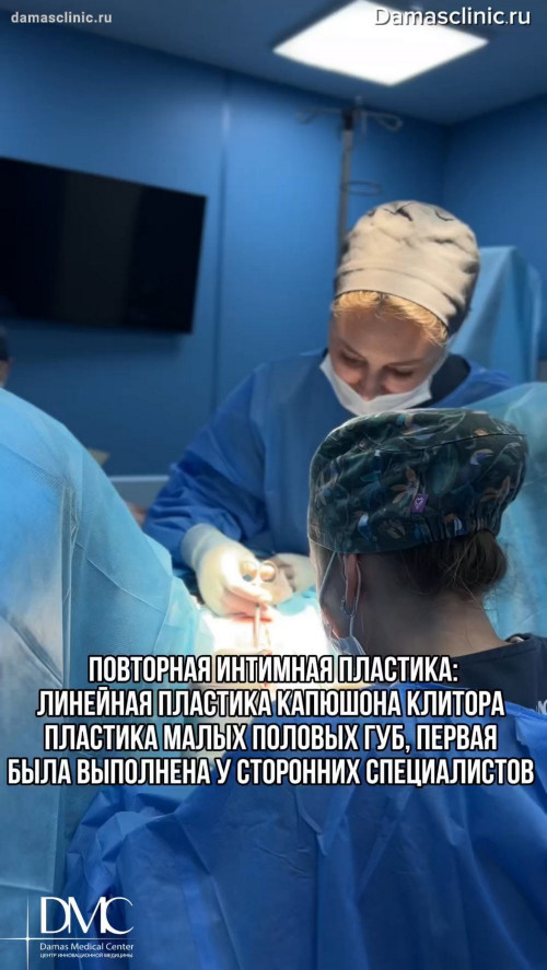 Повторная интимная пластика: линейная пластика капюшона клитора, пластика малых половых губ. Первая операция была выполнена у сторонних специалистов. Фото результатов