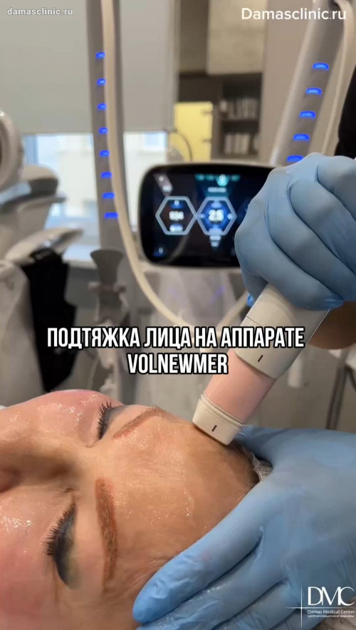 Подтяжка лица на аппарате VOLNEWMER / ВОЛЬНЬЮМЕР с видео