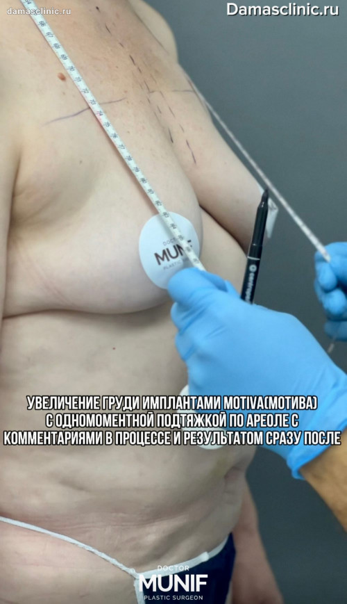 Увеличение груди имплантами MOTIVA (МОТИВА) с одномоментной подтяжкой по ареоле: комментарии в процессе и результат сразу после в видео