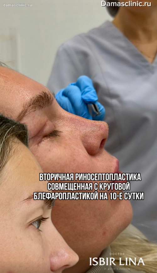 Вторичная риносептопластика, совмещенная с круговой блефаропластикой, на 10-е сутки (с фото- и видео-результатами)