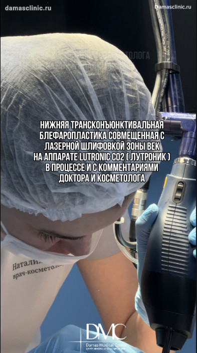 Нижняя трансконъюнктивальная блефаропластика, совмещенная с лазерной шлифовкой зоны век на аппарате LUTRONIC CO2 (Лутроник): в процессе и с комментариями хирурга и косметолога