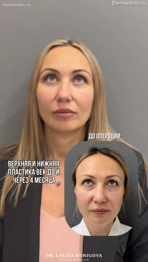 Верхняя и нижняя пластика век: до и через 4 месяца. От пластического хирурга Лалиты Магомедовны Кориговой
