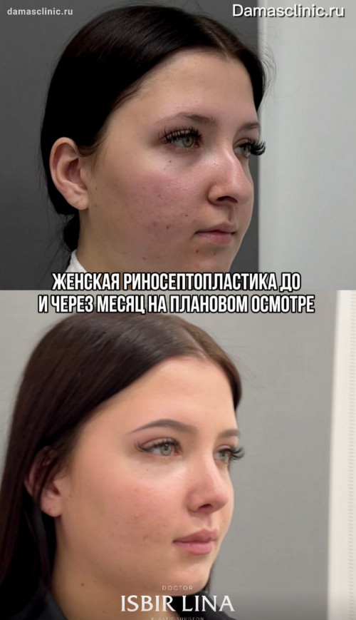 Женская риносептопластика: до и через месяц на плановом осмотре с видео-результатом