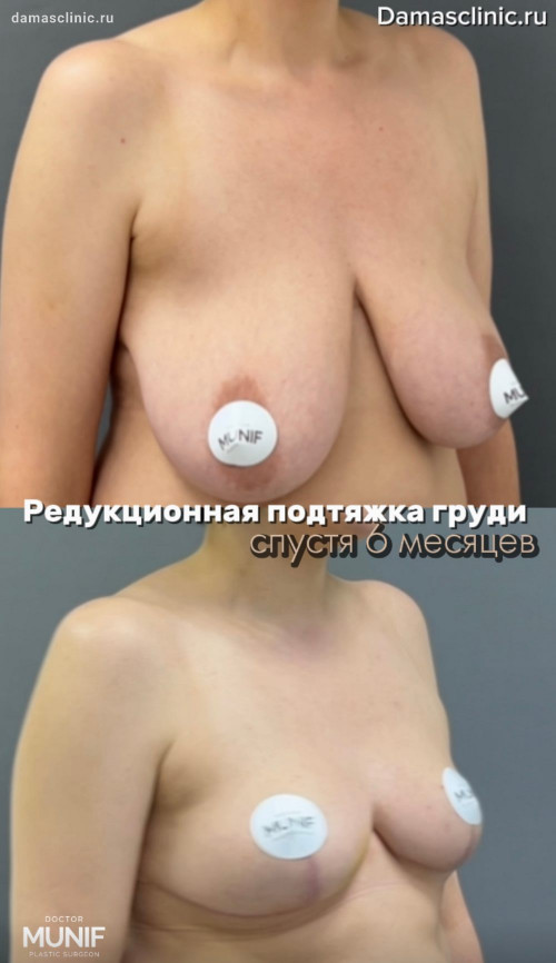 Как выглядят швы после якорной подтяжки груди через полгода?