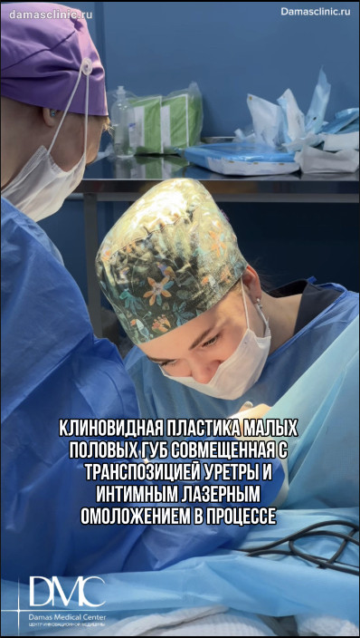 Клиновидная пластика малых половых губ, совмещенная с транспозицией уретры и интимным лазерным омоложением: в процессе
