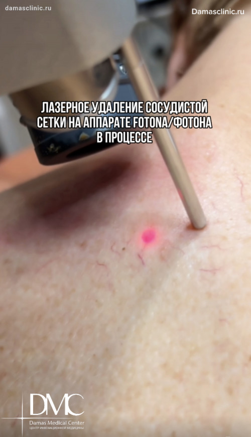 Лазерное удаление сосудистой сетки на аппарате FOTONA / ФОТОНА в процессе с видео-результатом