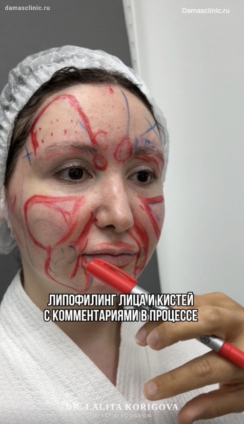 Липофилинг лица и кистей рук с комментариями в процессе: видео