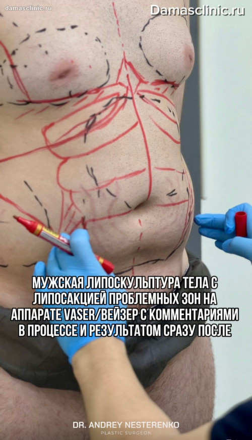 Мужская липоскульптура тела с липосакцией проблемных зон на аппарате VASER / ВЕЙЗЕР с комментариями в процессе и результатом сразу после (фото и видео)