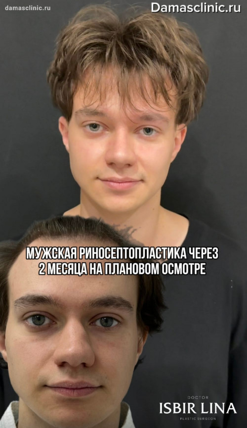 Мужская риносептопластика через 2 месяца на плановом осмотре с фото и видео