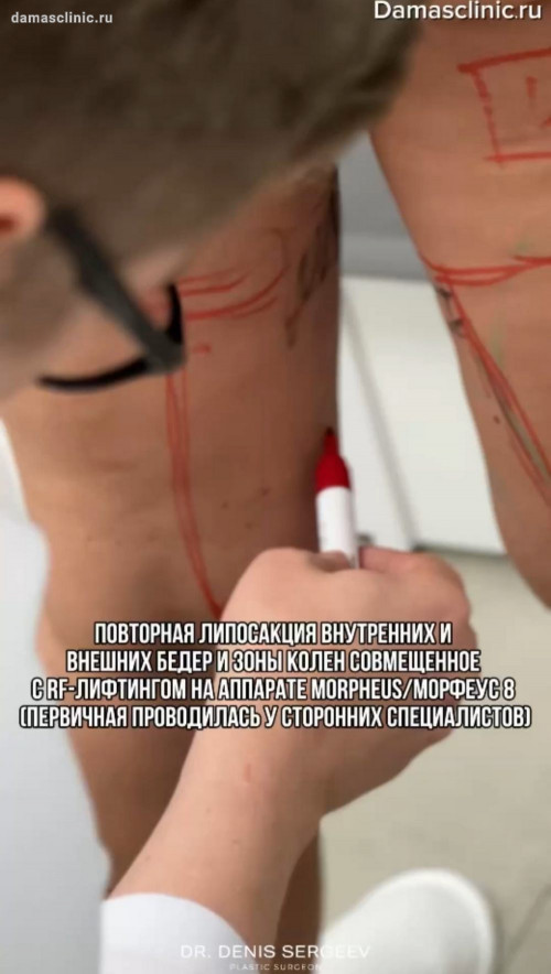 Повторная липосакция внутренних и внешних бедер и зоны колен, совмещенная с RF-лифтингом на аппарате MORPHEUS / МОРФЕУС 8 (первичная проводилась у сторонних специалистов) с видео