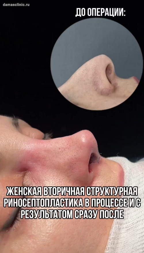 Женская вторичная структурная риносептопластика в процессе и с результатом сразу после (видео)