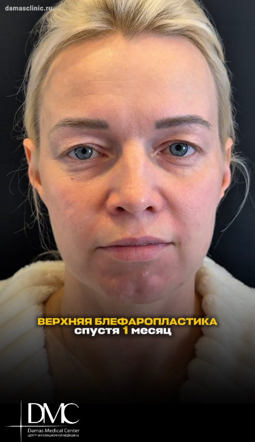 Верхняя блефаропластика спустя 1 месяц с фото и видео от пластического хирурга Игоря Александровича Горькова
